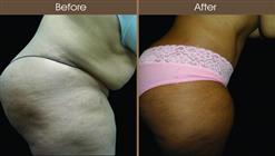 Abdominoplasty Surgery Before And After Right Side Image