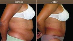 Before And After Abdominoplasty In New York
