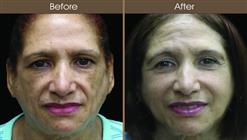 Cosmetic Injectables Before And After Front View