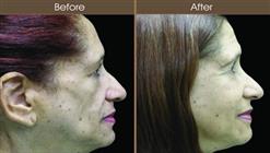 Cosmetic Injectables Before And After Right Side View