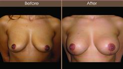 Breast Implant Before And After Front Image