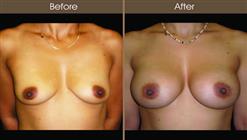 Breast Augmentation Before And After Front Image