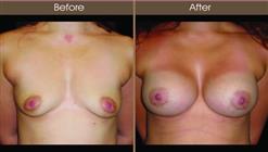 Breast Augmentation Before And After Front View