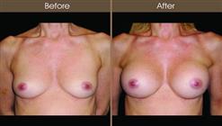 Breast Augmentation Surgery Before And After