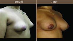 Breast Asymmetry Before And After Right Quarter View
