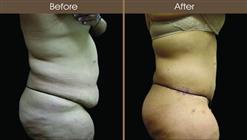 Buttock Lift Before And After