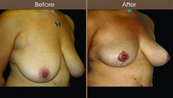 Breast Lift Before And After Right Quarter Image