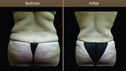 Lipo Before And After Back View