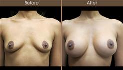 Breast Augmentation Before And After