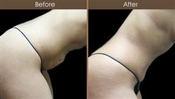 Mommy Makeover Tummy Tuck Results