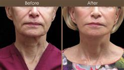 Facelift Surgery Before And After Front View