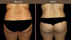 Before And After Lipo