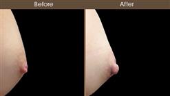Inverted Nipple Correction Results
