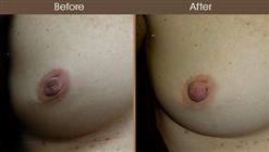Inverted Nipple Correction Before And After