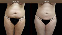 Liposuction Surgery Before & After Front Image