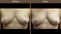 Nipple Correction Before And After
