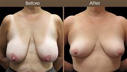 Before And After Breast Reduction Front Image