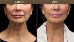 Before And After Neck Lift Surgery Front Image