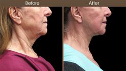 Before And After Facelift Right Side Image
