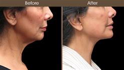 Before And After Facelift Surgery Right Side Image