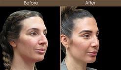 Before & After Nose Reshaping In New York City