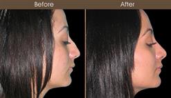 Nose Reshaping Results
