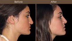 Before And After Rhinoplasty Treatment