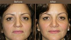 Before And After Rhinoplasty In New York
