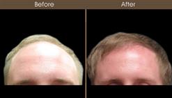 Hair Restoration Results