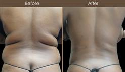 Gluteal Fat Transfer Before And After
