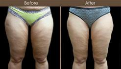 Before & After Thigh Lift Surgery