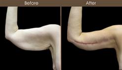 Before & After Arm Lift Surgery