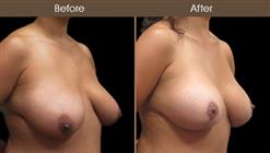 Breast Lift With Augmentation Before & After