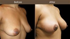 Breast Lift Surgery Results
