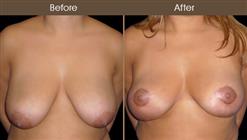 Before & After Breast Lift Surgery