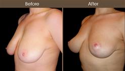 Before & After Breast Lift