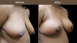 NYC Breast Reduction Results