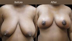 NYC Breast Reduction Before & After