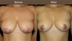 Breast Reduction Surgery Before And After Front Image