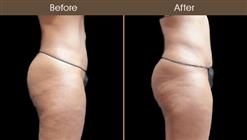 Before And After Tummy Tuck Surgery