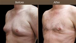 Male Breast Reduction Surgery Before & After