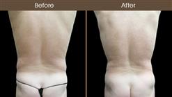 Before & After Male Liposuction