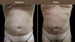Male Liposuction Before & After