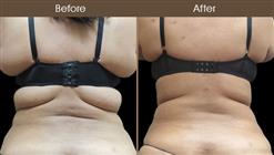 Lipo Surgery Before & After