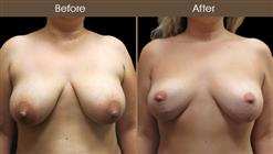 Before And After Breast Lift Front Image