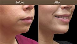 Chin Augmentation Surgery Before And After