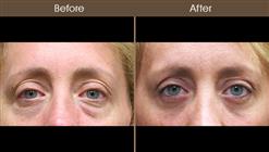 Before And After Blepharoplasty