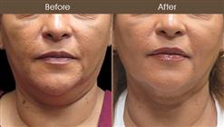 Scarless Facelift Surgery Before & After