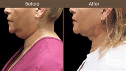 Scarless Facelift Surgery Results