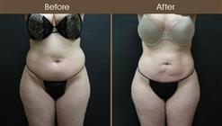 Lipo Surgery Before & After Front View